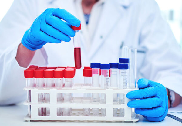 ACETYLCHOLINESTERASE (RBC)